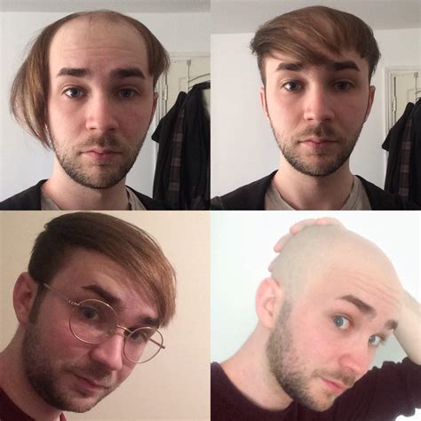 how i went bald .